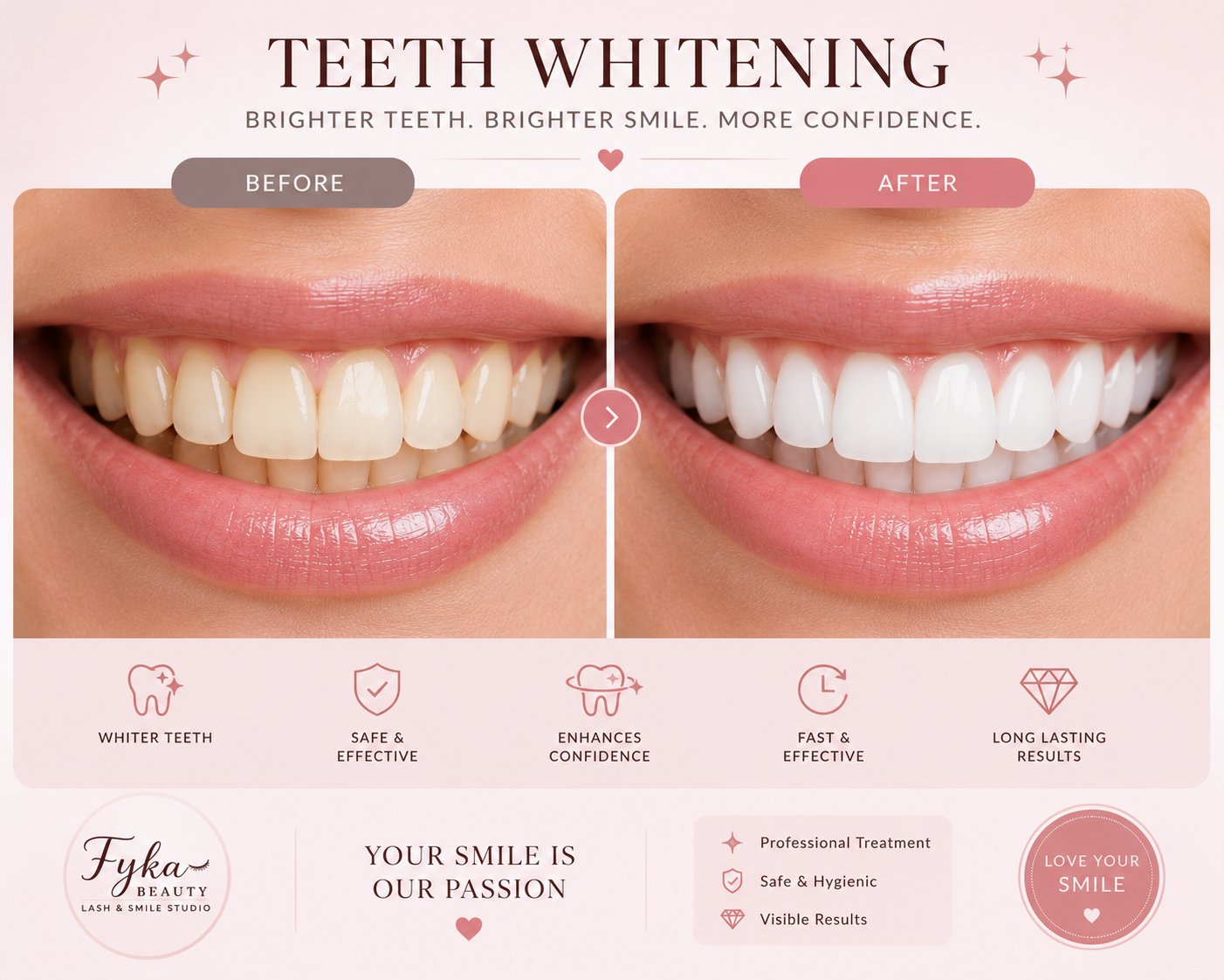 Teeth Whitening – Before & After